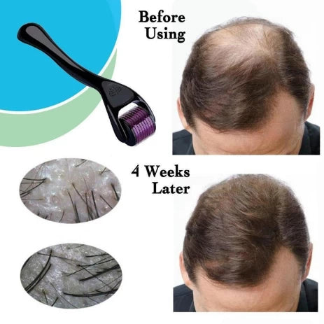 Derma Roller 0.5mm – Hair Growth, Beard Growth & Skin Microneedling Tool (540 Needles)
