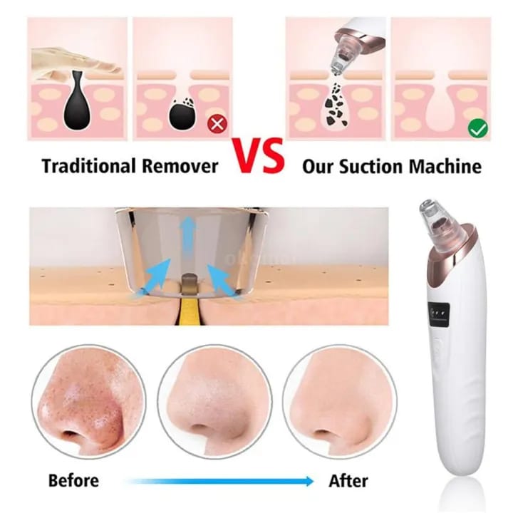 5 in 1 Derma Suction Blackhead Remover Vacuum | Electric Pore Cleaner Machine